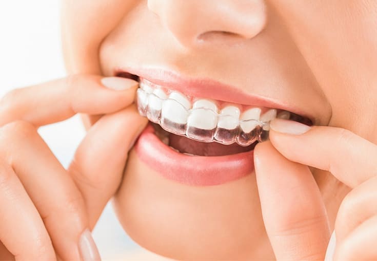 İnvisalign | Myndosdent - Bodrum Ağız ve Diş Sağlığı Kliniği