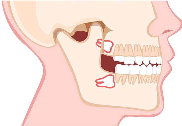 Wisdom Teeth And Impacted Teeth - Dental Clinic in Bodrum - Myndosdent