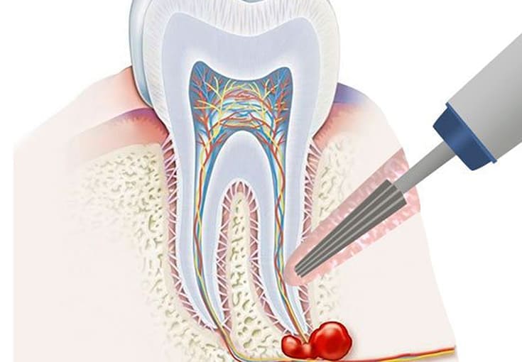 Apical Resection - Dental Clinic in Bodrum - Myndosdent