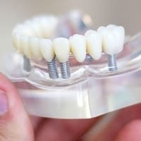 Dental Implant - Dental Clinic in Bodrum - Myndosdent