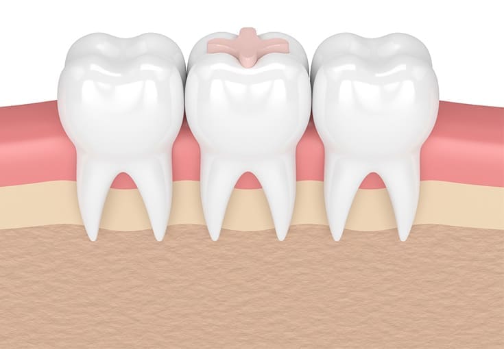 Inlay and Onlay Fillings - Dental Clinic in Bodrum - Myndosdent