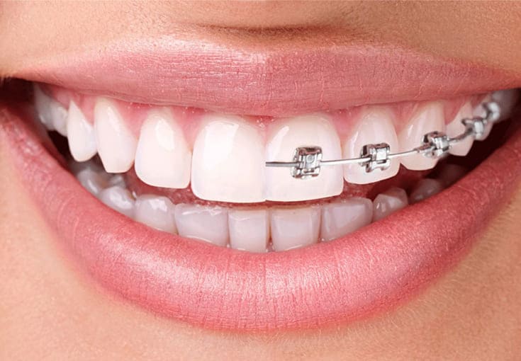 Orthodontics - Dental Clinic in Bodrum - Myndosdent