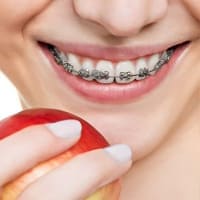 Orthodontics - Dental Clinic in Bodrum - Myndosdent