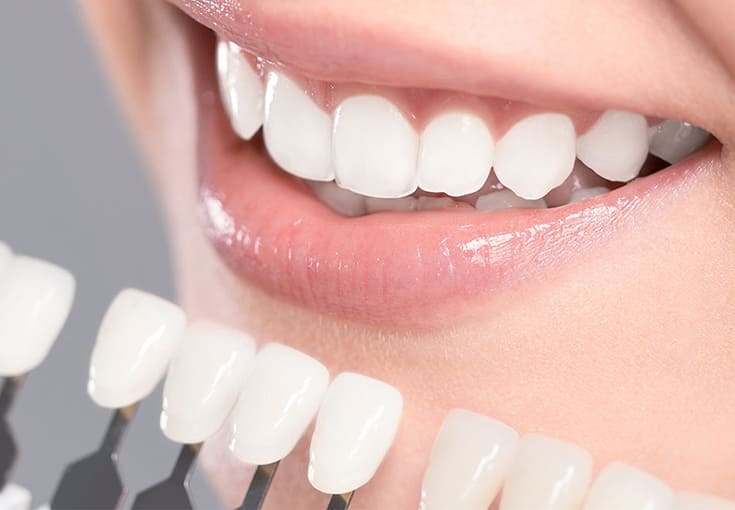 Porcelain Veneers - Dental Clinic in Bodrum - Myndosdent