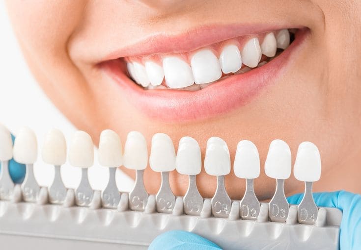 Zirconium Veneers - Dental Clinic in Bodrum - Myndosdent